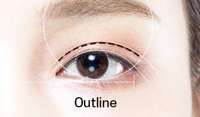 out-line double eyelid surgery