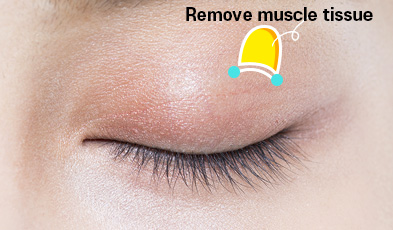 double eyelid surgery - Remove muscle tissue